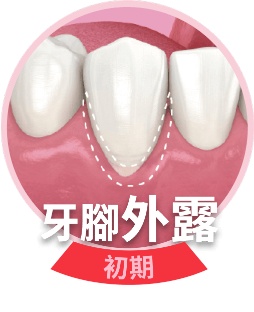牙腳外露初期