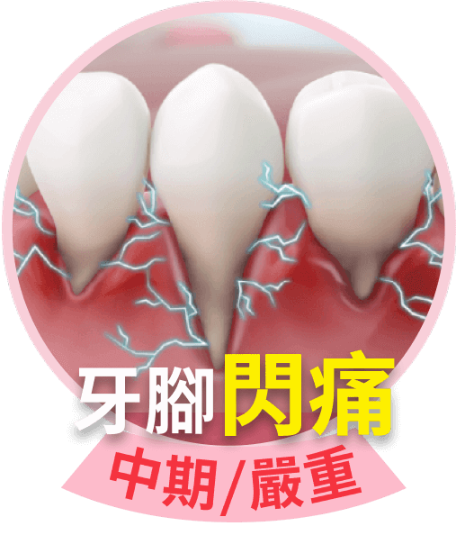 牙腳閃痛中期/嚴重